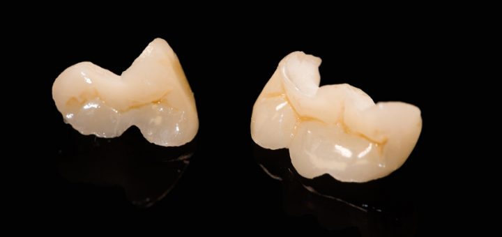 Keramikinlay auf schwarzer Glasplatte