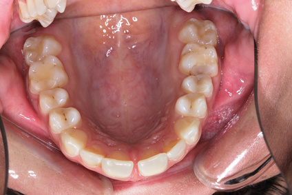 Weiße Zahnfüllungen durch Zahnarzt Dr. Lothar von Wittken
