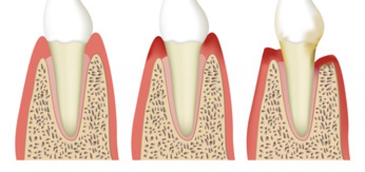 Paradontose Abbildung
