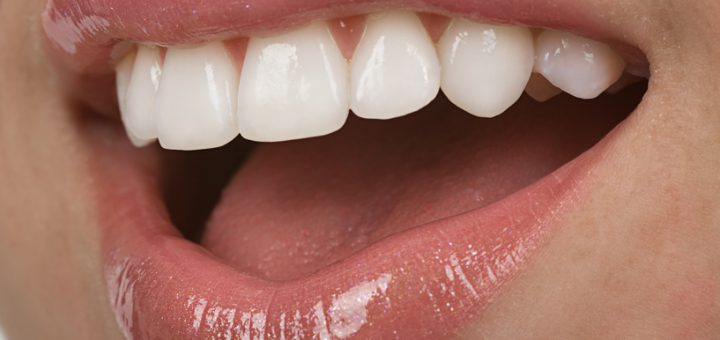 Veneers der unteren Schneidezähne vier Jahre nach dem Einsetzen.