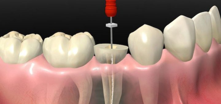 Wurzelbehandlung im Zahn